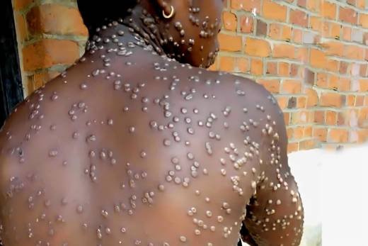 Caso suspeito do vírus Mpox notificado na província de Cabinda