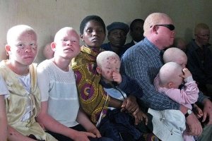 Albinos em Angola pedem ao Estado apoio social e medicamentos